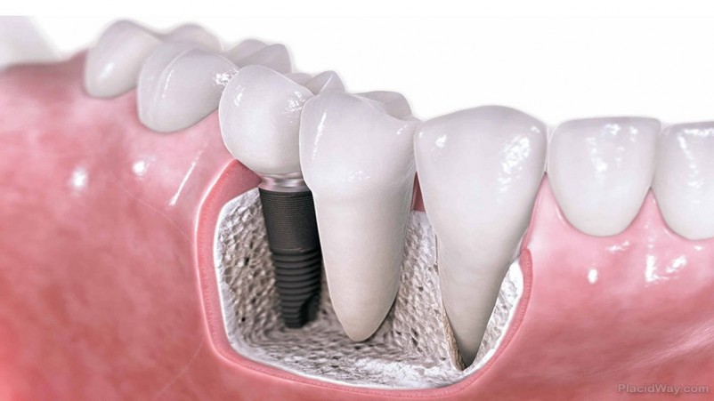 21 Things You Must Know About Dental Implants