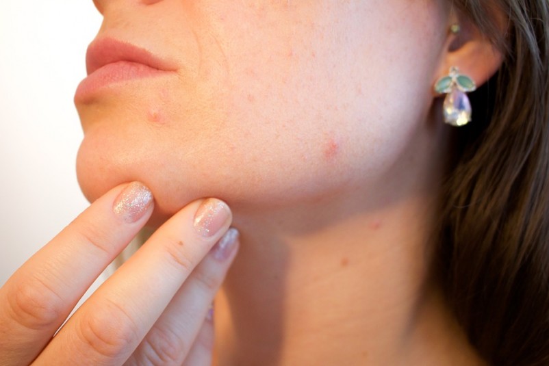 10 Things You Must Know About Acne
