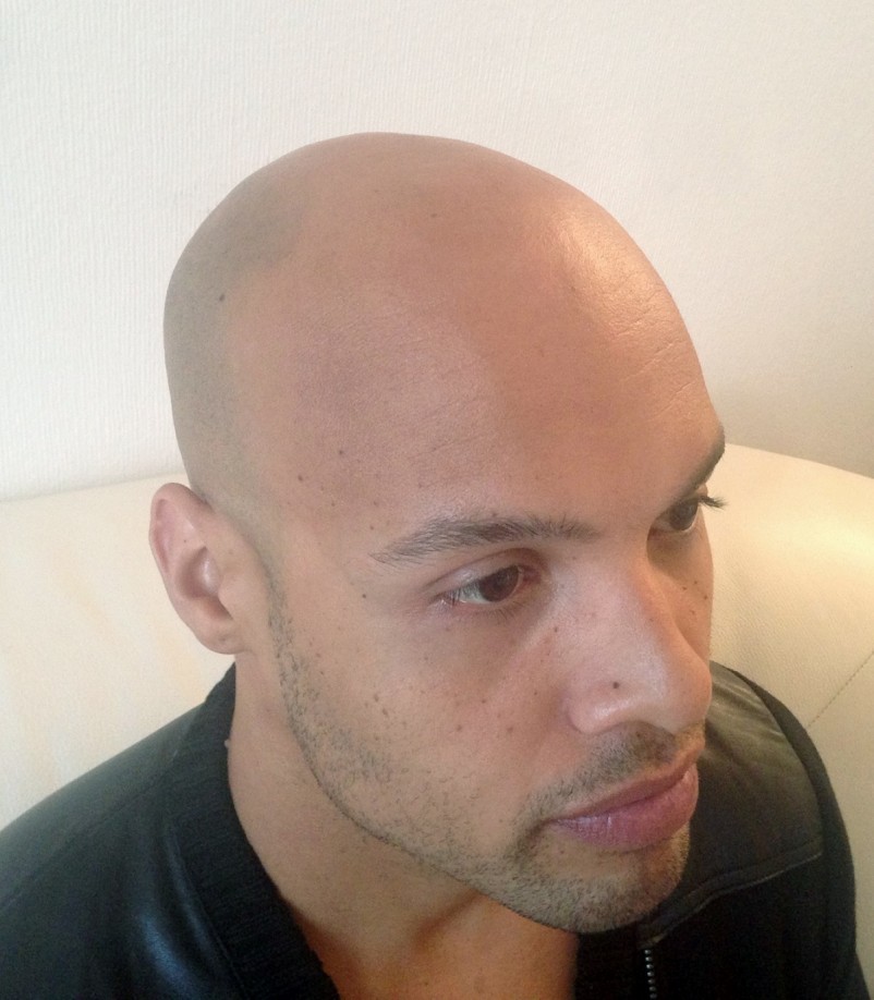 Best Hair Solution: Skalp.com